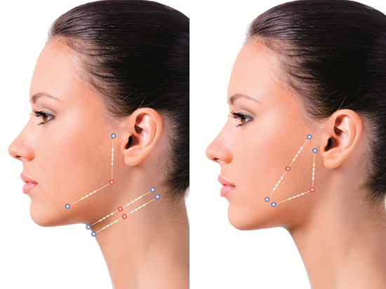 sutura-silhouette-tecniva-rejuvenescimento-facial